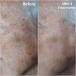 Before and after IPL pigmentation treatment