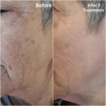 Before and after IPL pigmentation treatment