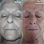 Before and after Venus Freeze skin tightening treatment
