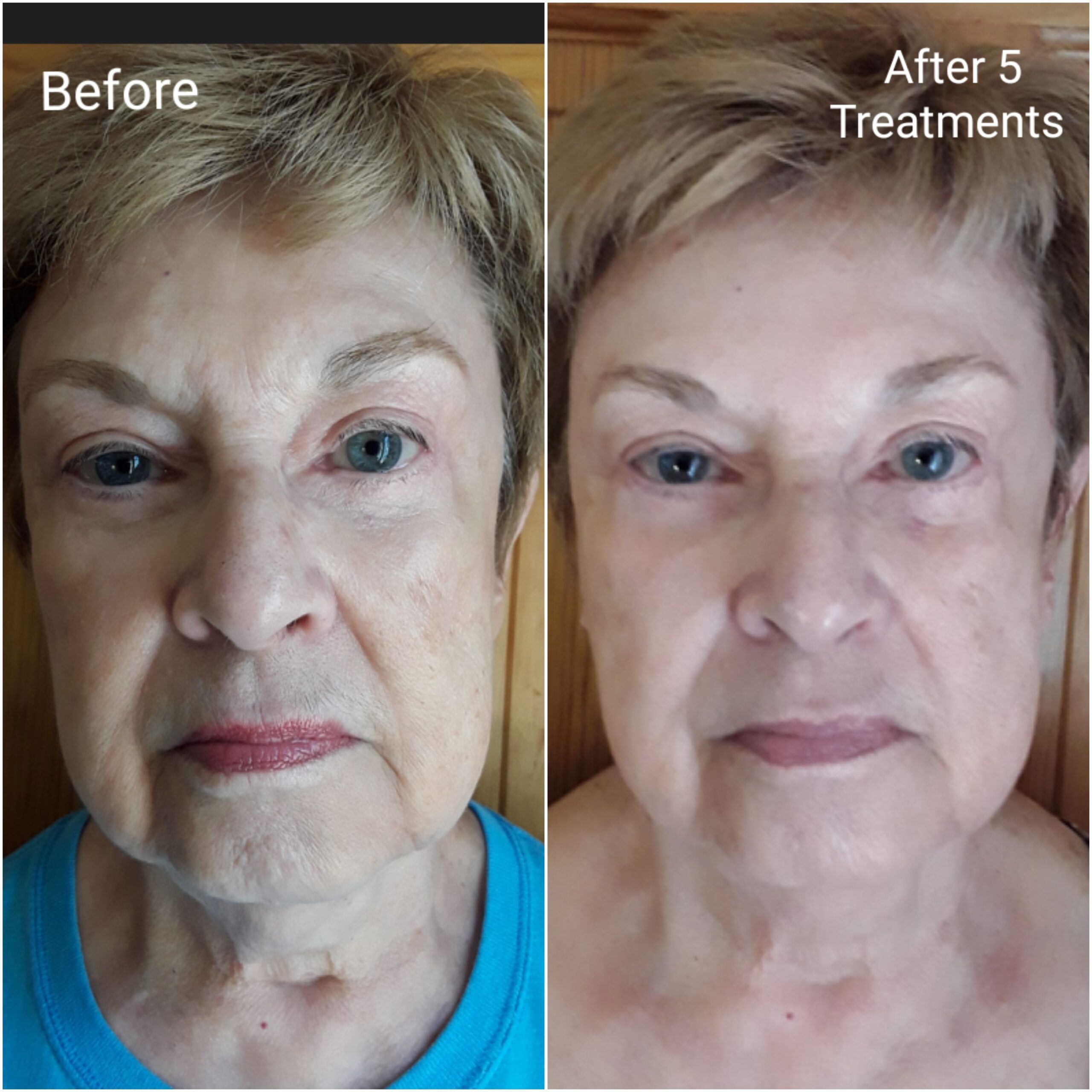 Before and after of RF skin tightening treatment