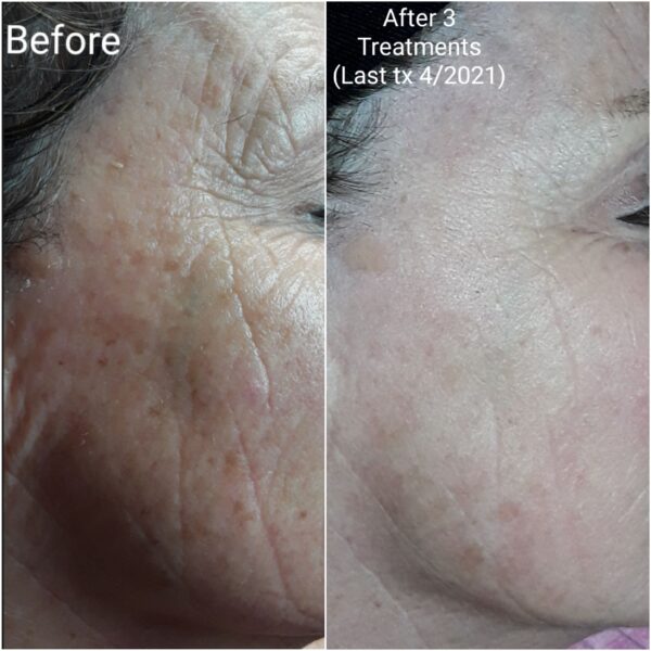 IPL for pigmentation before and after