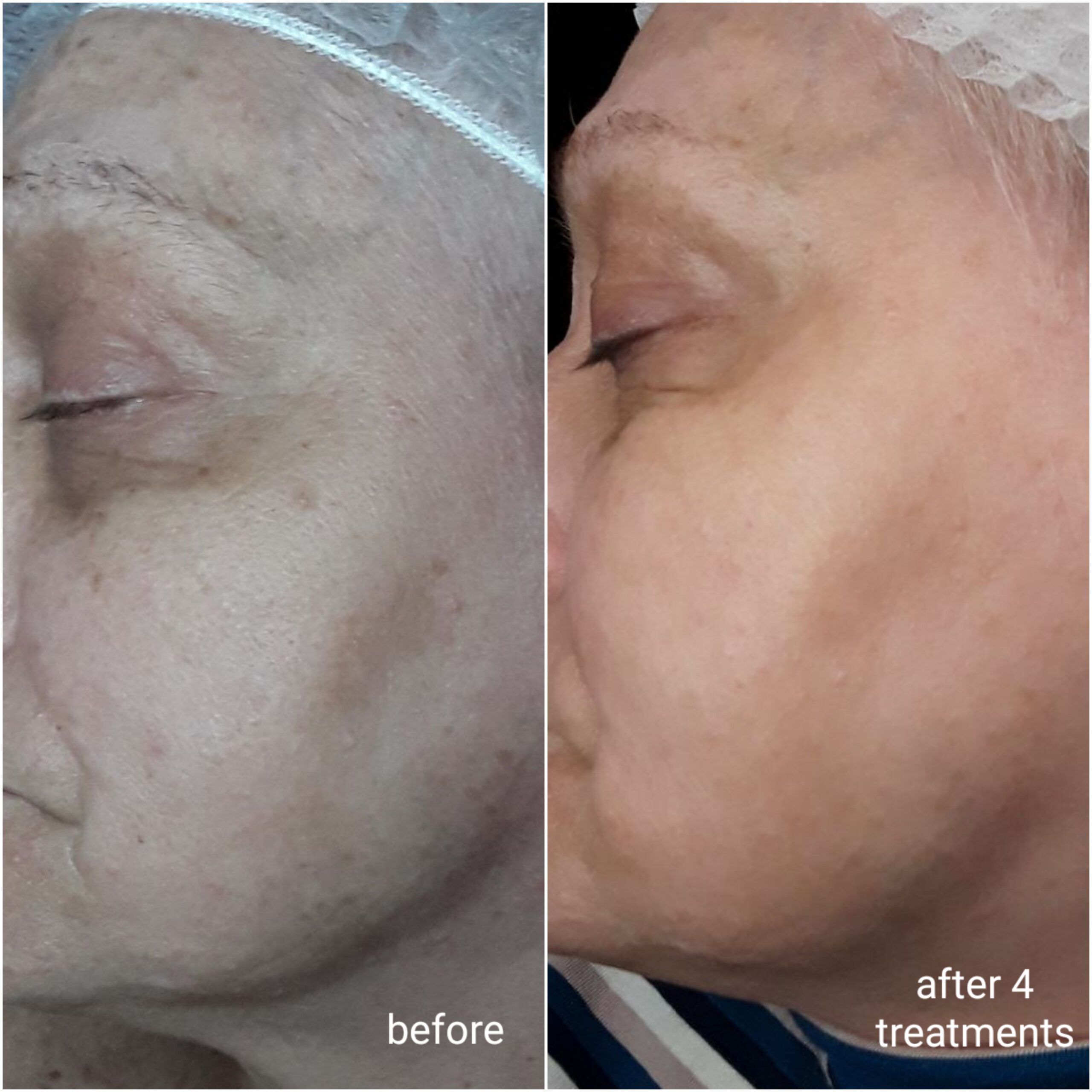 IPL pigment treatment before and after