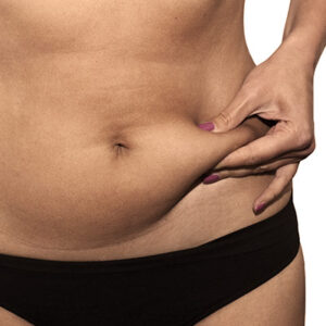 Woman with cellulite