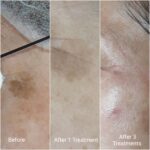 Before and after IPL pigmentation treatment
