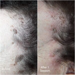Lamprobe treatment before and after