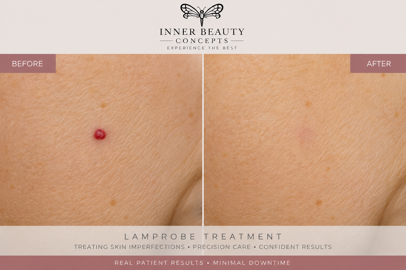 Before and after Lamprobe treatment for cherry angioma removal in Nashua NH