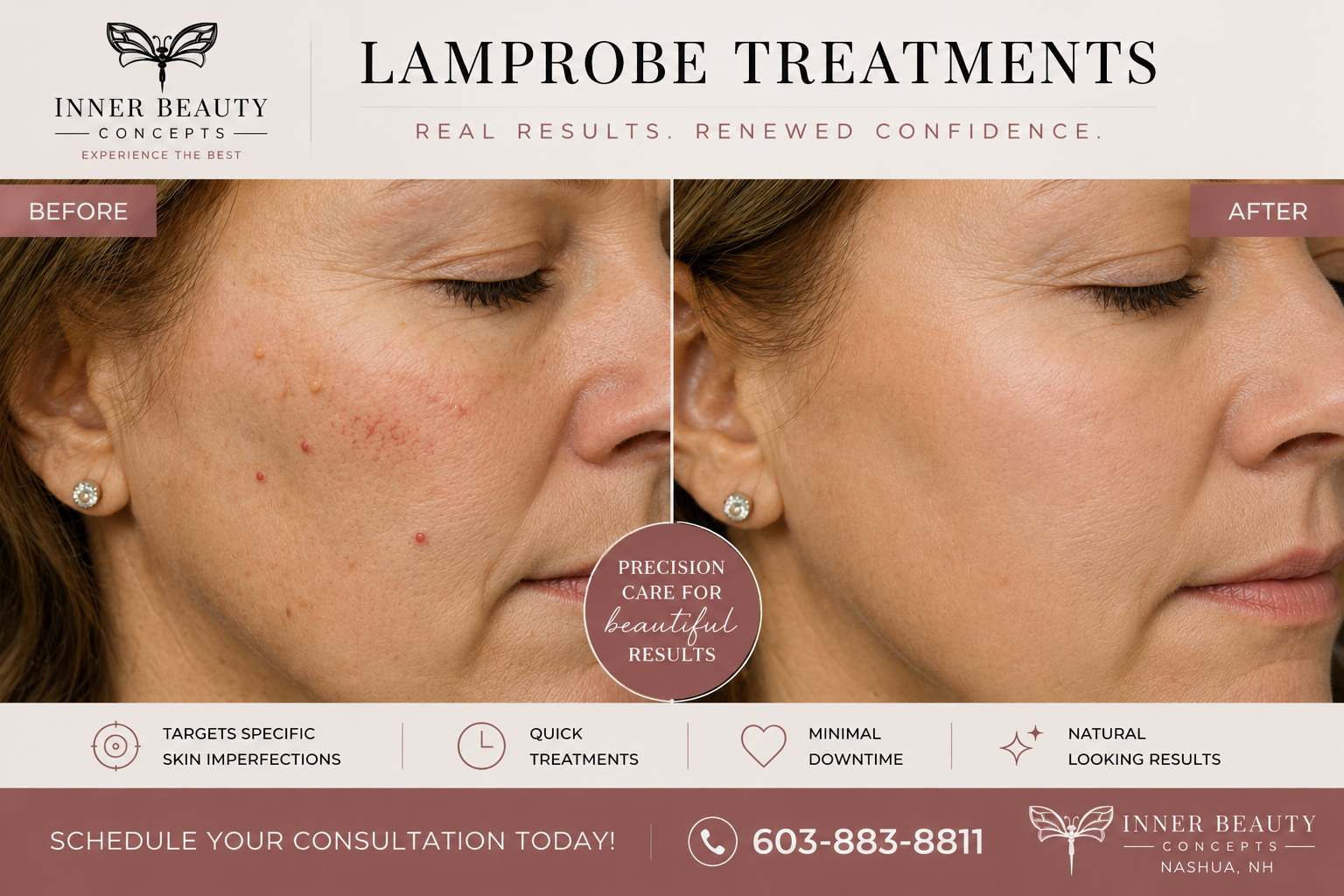 Lamprobe Treatments Nashua NH before and after treatment for skin imperfections