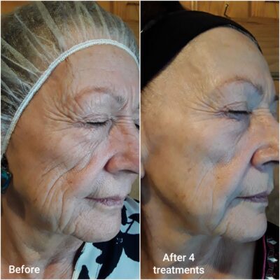 Before and after of RF skin tightening treatment